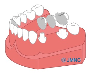 天白うめがおか歯科・矯正歯科が説明するブリッジ