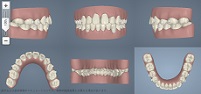 大垣アピオ歯科・矯正歯科のマウスピース矯正：インビザラインのシミュレーション