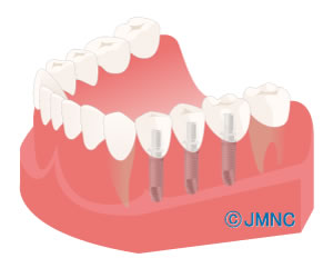 天白うめがおか歯科・矯正歯科が説明するインプラント２
