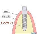 天白うめがおか歯科・矯正歯科が説明する２次処置