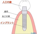 天白うめがおか歯科・矯正歯科が説明するインプラント完成