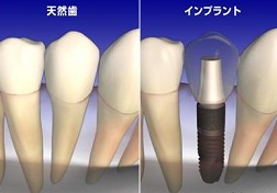 天白うめがおか歯科・矯正歯科が説明するインプラントのイラスト１