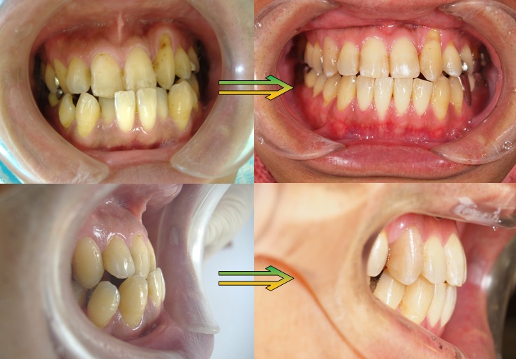 天白うめがおか歯科・矯正歯科のインプラント症例紹介４