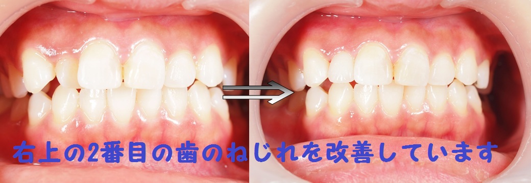 名古屋市天白区でインプラントやマウスピース矯正インビザラインに力を入れる歯科医院、天白うめがおか歯科・矯正歯科の審美歯科治療