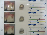 名古屋市天白区でマウスピース矯正とインプラントに力を入れる天白うめがおか歯科・矯正歯科の歯のスキャニング