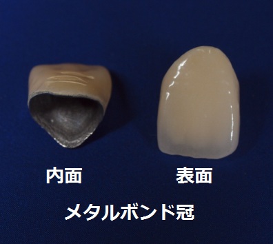 名古屋市天白区でマウスピース矯正とインプラントに力を入れる天白うめがおか歯科・矯正歯科のメタルボンド
