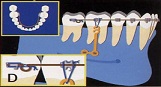 名古屋市天白区でインプラントやマウスピース矯正インビザラインに力を入れる歯科医院、天白うめがおか歯科・矯正歯科のインプラント矯正